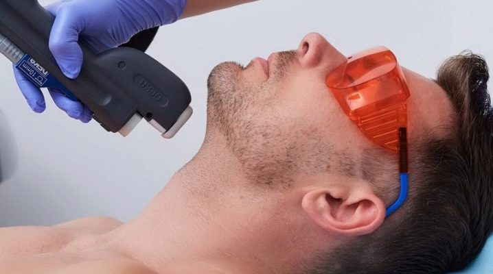 Depilação a laser para homens