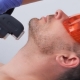 Lasersko uklanjanje dlaka za muškarce