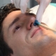 Ako odstrániť chĺpky z nosa?